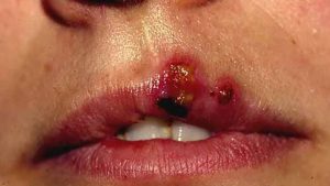 Cold_Sore_Stages