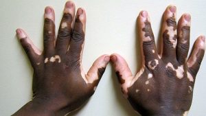 Colitis_Skin_Rash