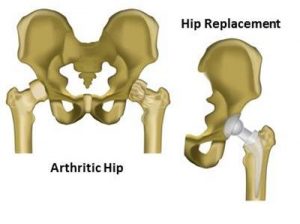 total-hip-replacement-diagram-2