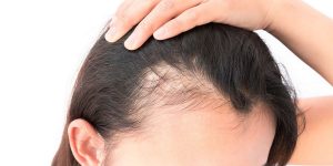 hair loss picture