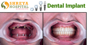 Dental implant