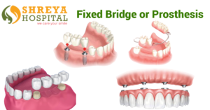 Fixed Bridge or Prosthesis