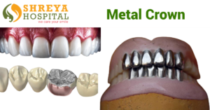 Metal Crown