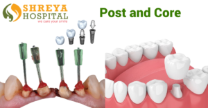 Post and Core