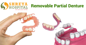 Removable Partial Denture