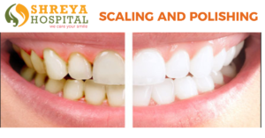 Scaling and Polishing