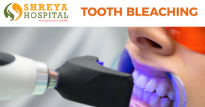 Tooth bleaching