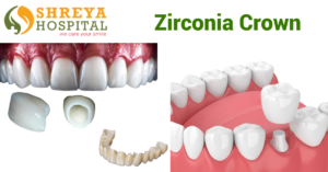 Zirconia Crown
