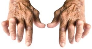 arthritis