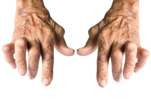 arthritis