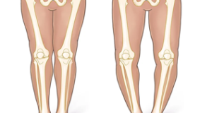 bow-leg1
