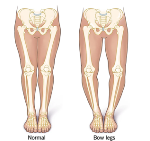 bow-leg1