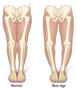 bow-legs