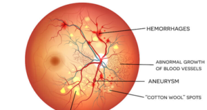 dibetic-retinopathy