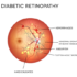 dibetic-retinopathy