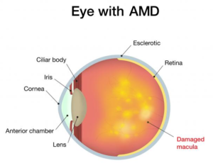 eye-AMD