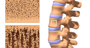 osteoporosis