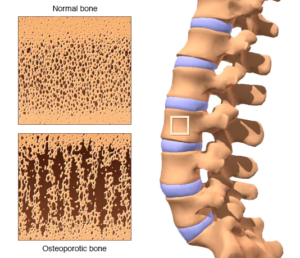 osteoporosis
