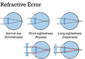 refractive-error