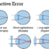 refractive-error