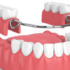 removable-partial-denture