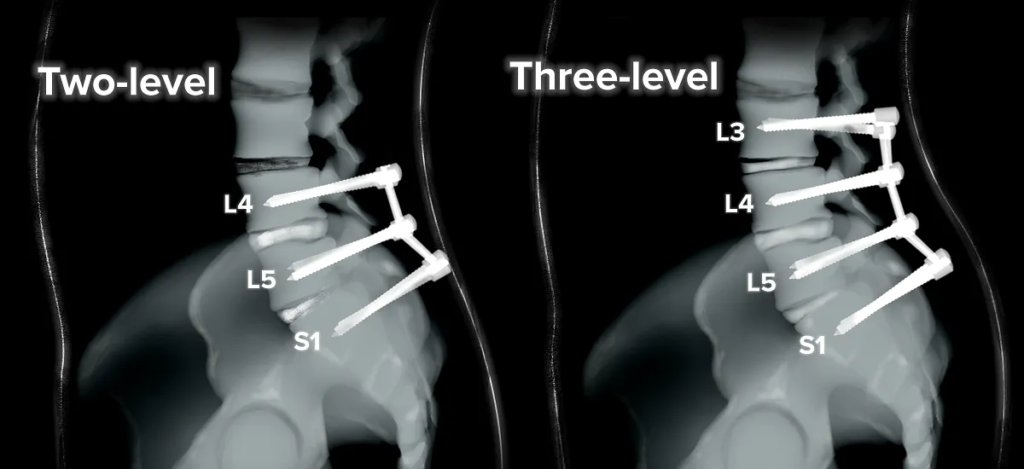 Multilevel Spinal Fusion Surgery